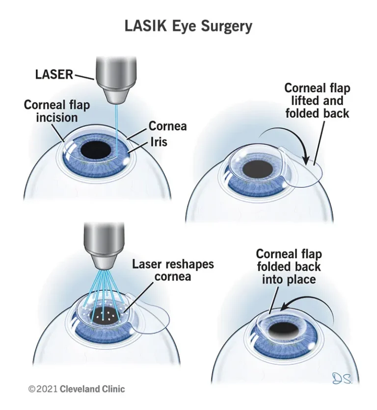 Astigmatism eye surgery in India