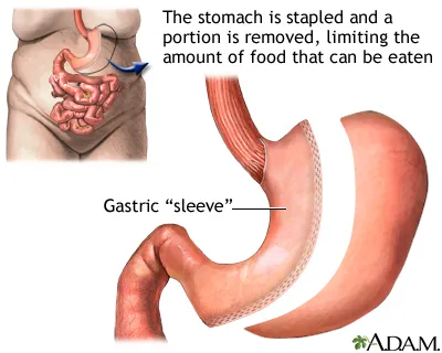 Gastric Sleeve Surgery in Turkey