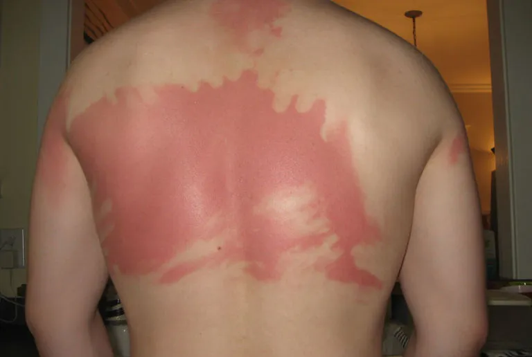 hormones and sun sensitivity