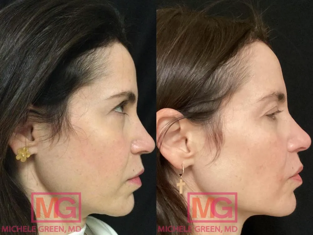 Non-Invasive Face Lifting