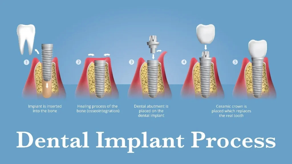 Dental Implants