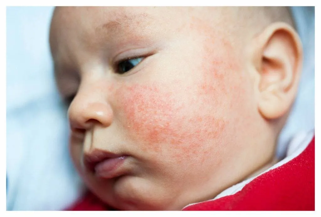 Baby Eczema and Asthma Prevention