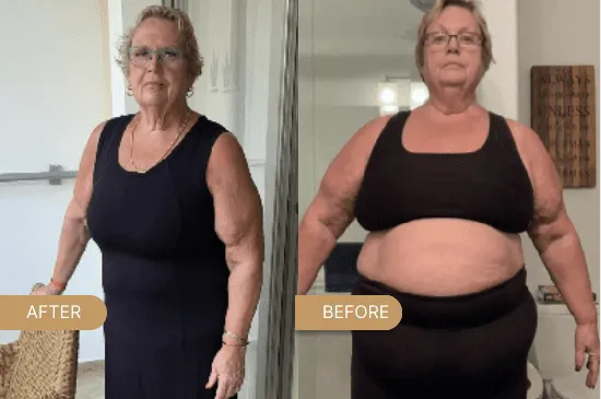 Gastric Sleeve Surgery in Turkey