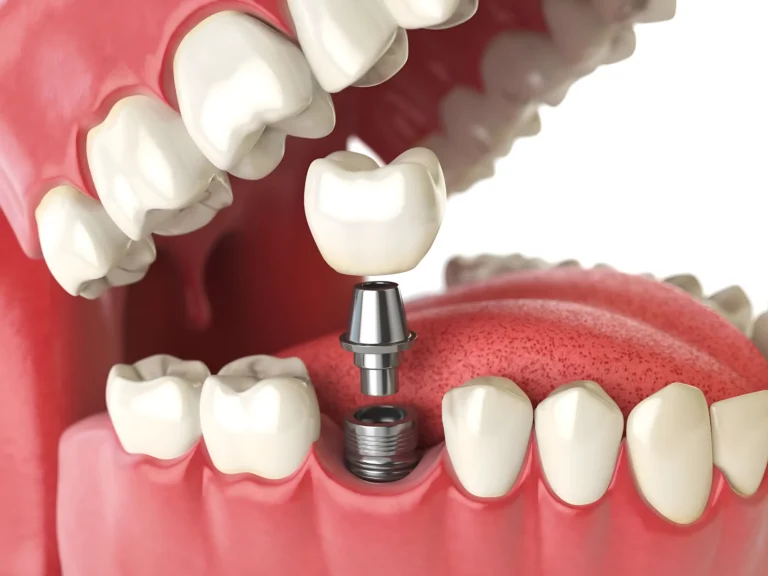 Dental Implants Middlesbrough