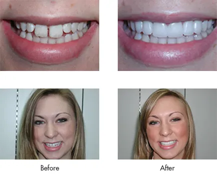 Hollywood Smile in Turkey