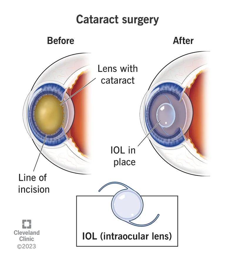 Cataracts
