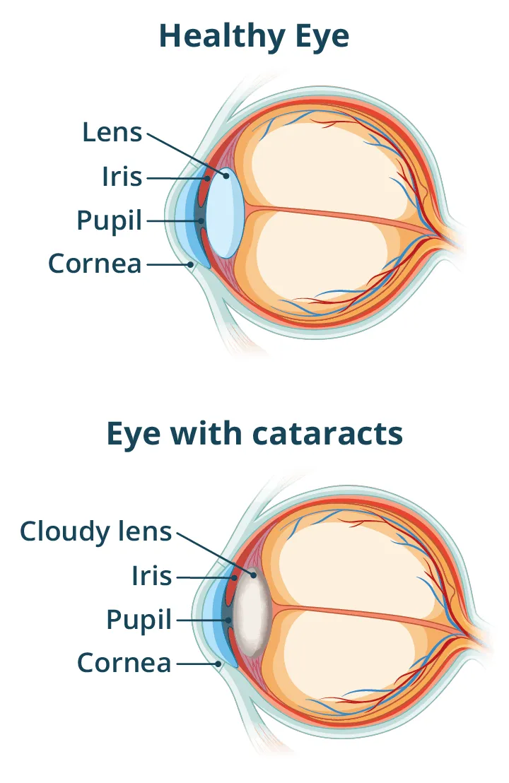 Cataracts