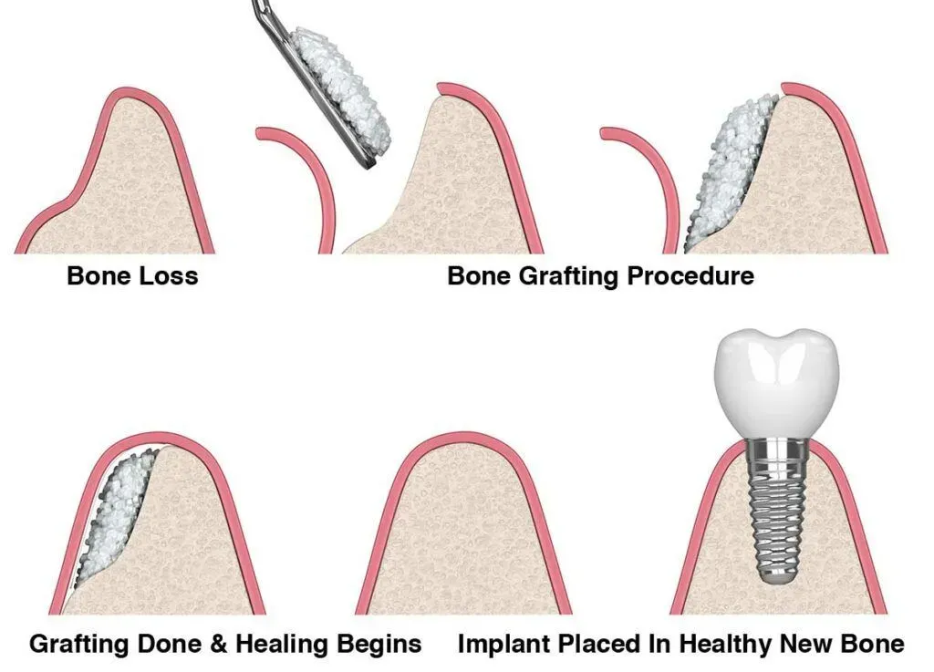 Dental Implants Turkey Cost