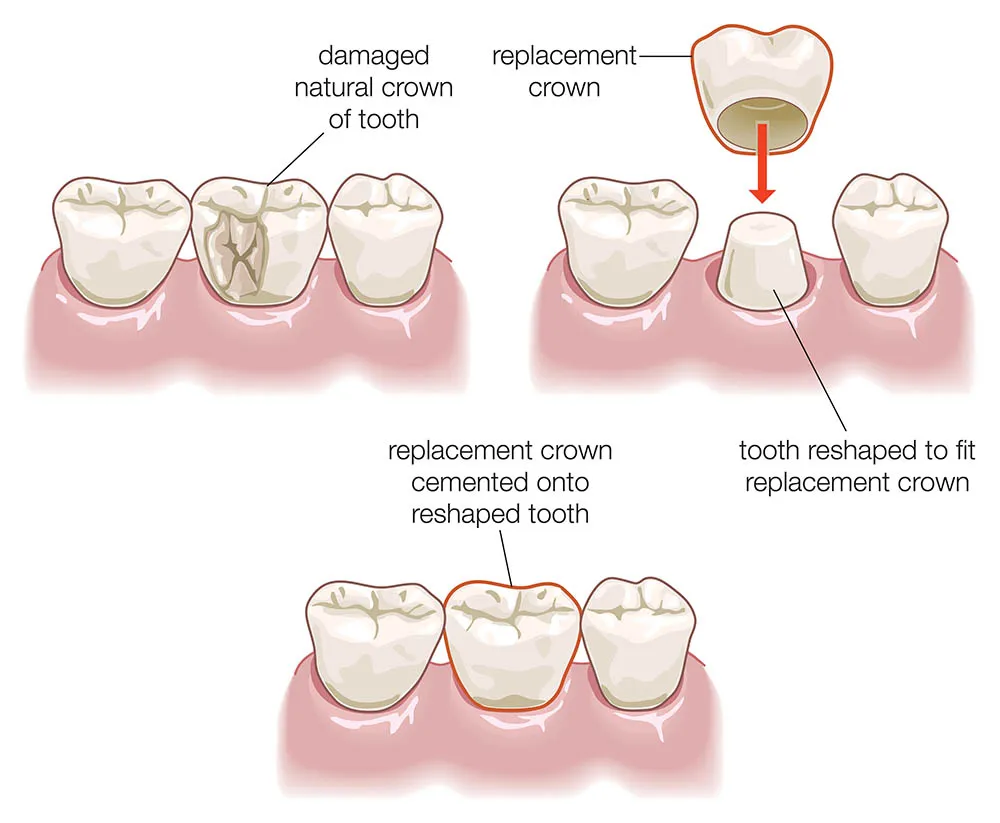 Dental Crowns