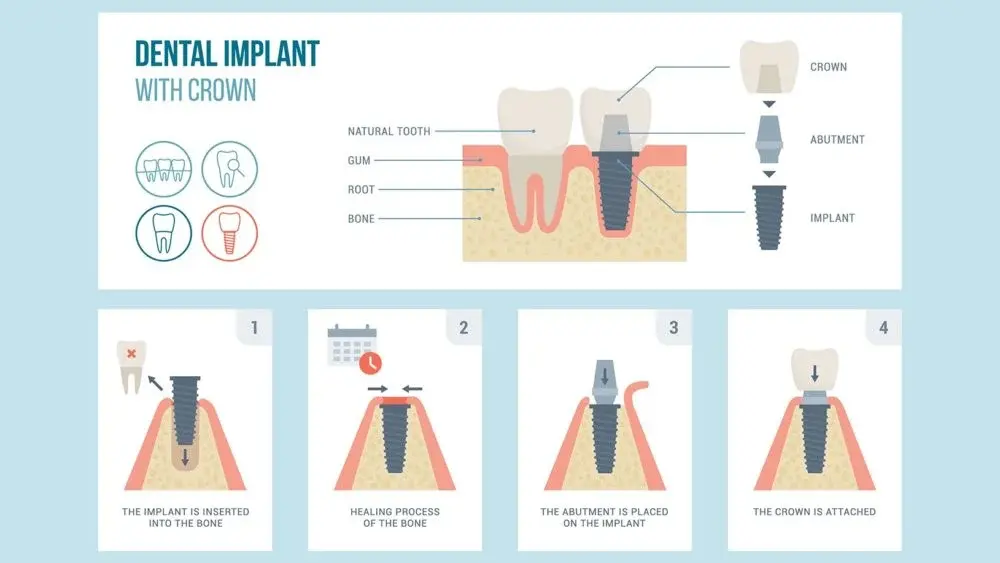 Dental Implants
