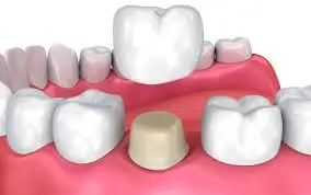 Dental Crowns