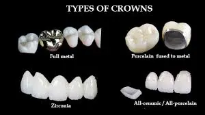 Dental Crowns