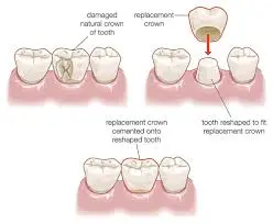 Dental Crowns