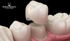 Dental Crowns