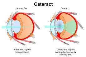 Cataracts