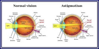 Astigmatism eye surgery in India