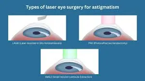 Astigmatism eye surgery in India