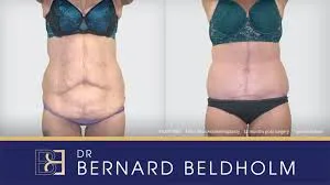 Fleur-de-lis tummy tuck surgery in Delhi