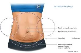Fleur-de-lis tummy tuck surgery in Delhi