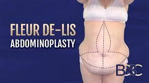 Fleur-de-lis tummy tuck surgery in Delhi