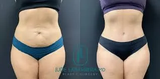 Fleur-de-lis tummy tuck surgery in Delhi