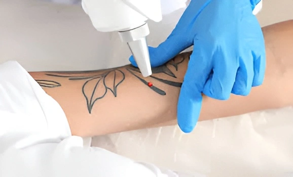 Tattoo Removal