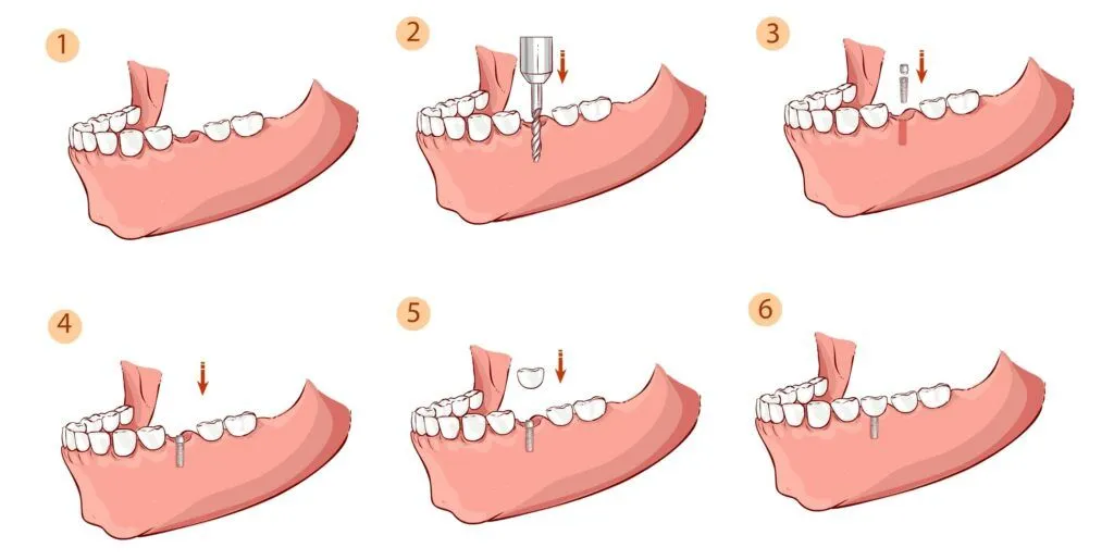 Dental Implants Turkey Cost