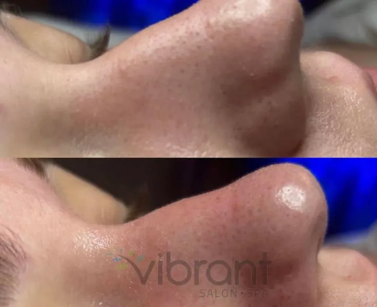 HydraFacial Treatment 