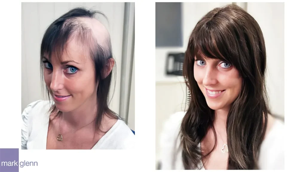 Hair Systems for Women